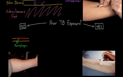 آزمون پوستی توبرکولین Tuberculin Skin Test (TST) (PPD)